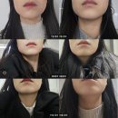 닥터에버스의원에서 사각턱보톡스 맞은 후기 내돈내산