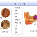 ﻿급성 중이염 증상과 치료법에 대해서 이미지