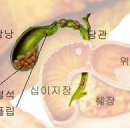 담낭 담석증 자료 이미지