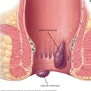 치질(hemorrhoid) 자연치유, 미량원소치유법 - 마그네슘, 비타민 C 이미지