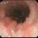 [위내시경] 상부식도암(Squamous cell carcinoma) 이미지