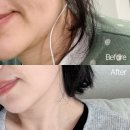 준 소프트 | 실루엣소프트 유지기간 실루엣플리프팅 심부볼 팔자주름 2주 후기