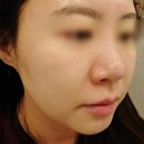 수원-0345 | 인계동피부관리추천, 웨딩관리로 윤곽관리한 후기 키웰 수원인계점