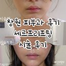 동그리멍 | 창원피부과에서 요즘 핫한 박신혜리프팅 세르프 리프팅 받고 온 후기