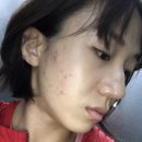 예사랑피부과 | 예사랑 피부과 @ 시너지 레이저 리얼 후기