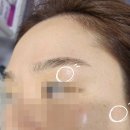 빈센트의원 | 내돈내산 빈센트의원 흑자제거 리팟레이저 후기