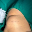 다산육종 | 남양주 다산 지방종 제거 수술 잘하는 곳 후기