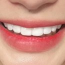 이코어치과기공소 | 무삭제 치아라미네이트 블랙필름 후기 비용 가격 + 부작용 (내돈내산)