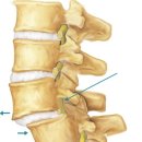 4번5번 척추...때문에 엉치뼈 아파서....[허리디스크 고주파시술 후기] 이미지