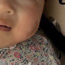 장기반점 | [밀크반점 치료] 리멤버피부과 1회~5회차 치료 후기