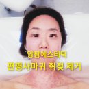 앙팡곱창 | 미사 피부관리숍 앙팡 에스테틱 편평사마귀 쥐젖 제거 후기 주의사항
