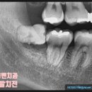 서울프리벤치과의원 네이버블로그