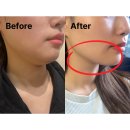 타이트짐 | 대전 둔산동 올타이트 400샷 얼굴 리프팅 시술 일주일 솔직후기