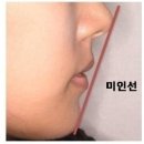 불로치과의원 | 양악수술.. 망하는 이유는?바로 이것 입니다 ㅠㅠ이럴때는 양악하지 마세요.. 체크리스트!!