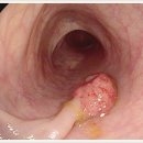 대장내시경 / 용종 이미지
