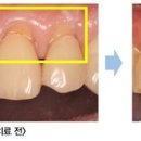잇몸내려앉음 이가시린이유 충치 이시림 시린이 이미지