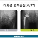 [고관절인공관절수술] 고관절 골절, 초기에 관리 필요 이미지