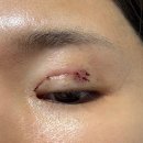 세븐일레븐 대구드림병원점 | 대구 쌍수 재수술 병원 선정부터 수술후 세달차 후기 (+결국 또 재수술 했습니다)