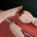 (고통주의) 부러진 쇄골 치료방법.GIF 이미지