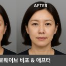 웨이브의원 | 대전 힐로웨이브 시술 효과와 후기 – 메이드유의원 병원