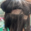 리즈모의원 | 머리 뚜껑 심기,, (헤어라인 모발이식) 🧑🏻‍🦲🙆🏻‍♀️ 내돈내산 !