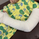 수지한빛정형외과의원 | [꽁냥🐰주말일기] 💔 놀이터에서의 쿵! 팔꿈치 골절😨우리 둘째의 깁스 이야기