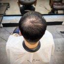 40 | 이천 탈모커버 잘하는 곳 찾는다면? 수원까지 찾아오는 40대 남성 링거펌 후기