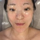 [초량피부관리 후기] 리안뷰티에서 카복시팩 + 물방울리프팅 + 트러블 집중관리 받고 왔어요! (초량웨딩...