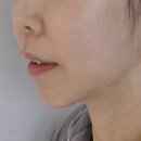 대기에너지(주) | 송도피부과 텐써마 300샷 찐후기 고현정리프팅·팔주주름리프팅 후기