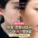 한뷰티샵 | 출산 후 목에 퍼진 쥐젖·편평사마귀, 오송 한뷰티샵에서 제거한 솔직후기