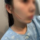리본성형외과의원 | [신사역성형외과 리본성형외과 추천] 실로만리프팅 솔직후기, 처진 턱선 심부볼 고민 해결 ✨