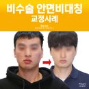 미소자인교정치과의원 | 얼굴비대칭교정기 3개로 수술 못지않는 효과 얻는 방법