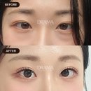 로드성형외과의원 | 결혼식 D-30, 피곤해 보이는 눈밑을 눈밑지방재배치로 충전! | 20대 후반 눈밑지 후기 (드라마성형외과)