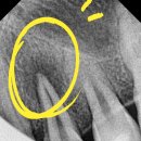 최치과의원 | 치외치란? 치료 후기. 성남 분당 경기도광주 치과