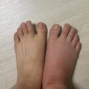 안식 미용실 | 만성발목불안정증 MBO 수술 후 회복기 1