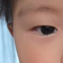 조은안과의원 | 부산 당감동 누네조은안과에서 아기 눈물길 폐쇄/눈물샘 막힘 시술(탐침술) 후기