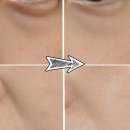 대박양봉 | 밴드스토어 고주파 디바이스 | 눈밑 꺼짐, 팔자주름에 효과 미쳤다!