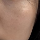 비비엘 | 청담 피부과 IPL BBL 비비엘 레이저 후기, 잡티 기미 개선