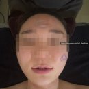 벤뷰티 | 일산백석여드름관리 벤뷰티 여드름 압출 잘하는 곳 추천후기