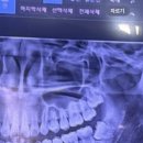 아픈 사랑니