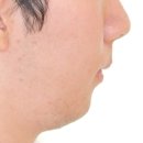 상하치과의원 | 성인 악궁확장 치아교정 후기(+발치)