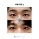 안병준성형외과의원 | 여자의 쌍꺼풀과 다르다?! 남자의 눈성형 쌍꺼풀 사례