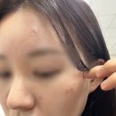 바른빛한의원 | 창원 피부과 수두흉터 치료(울트라 펄스 앙코르 레이저, 서브 시전) 내돈내산 후기