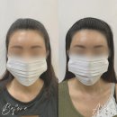 안산두피문신, 자연스럽게 달라진 헤어라인 후기