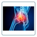 씨유 당진수청타워점 | 당진유도 &#39;억!&#39; 젊은층 고관절 통증, 당진한의원 치료 후 운동 복귀 리얼 후기