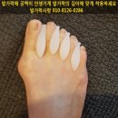 발가락운동용구 듀트 착용하고 신체발란스운동하여 무지외반증 개선하세요 이미지