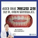경주바른이 치과교정과 치과의원 | 굽은다리역치과 40대 여성 개방교합 교정 후기｜3년 전후 변화 사례