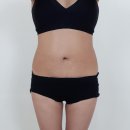 모래시계의원 | 지방흡입, 지방이식 '싼 곳'의 함정! 가격보다 중요한 것. (EP. 25-19)