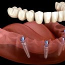 아치치과기공소 이미지