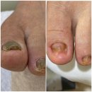 레푸스 평택소사벌점 | 평택 발톱무좀 케어 잘하는 레푸스 평택소사벌점 후기